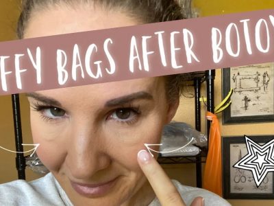 Eye Bags After Botox Treatment