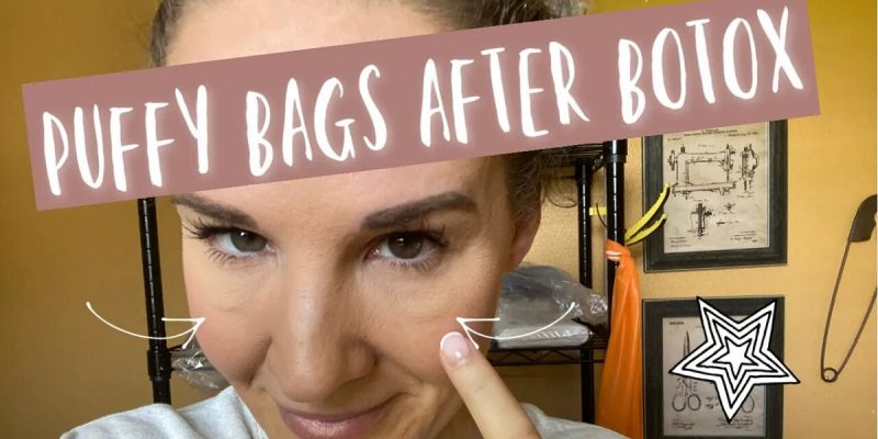 Eye Bags After Botox Treatment